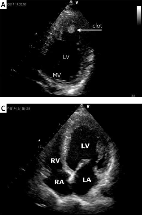 Figure From Acute Myocardial Infarction Due To Coronary Embolism