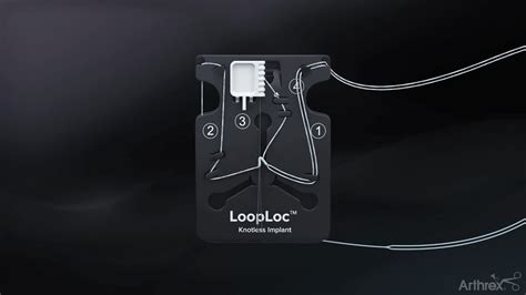 My Experience Using Looploc™ Knotless Implants Youtube