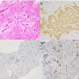 A Hematoxylin And Eosin Stained Brain Biopsy Specimen Showing Small