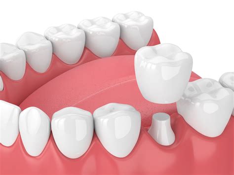 How Long Do Dental Crowns Last Prosper Dental Health