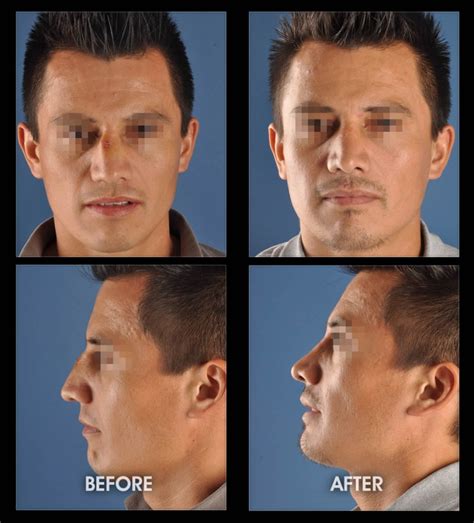 Male Rhinoplasty Before And After Photos Los Angeles