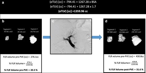 Assessment Of Liver Hypertrophy Following Right And Segment 4 Portal