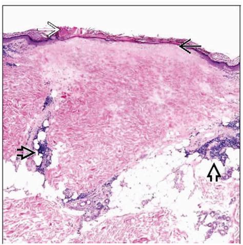 Degos Disease | Basicmedical Key