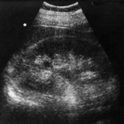 Ultrasound shows an intraluminal echogenic focus with an acoustic ...