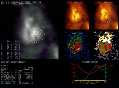 MUGA Scan - Hamilton Cardiology Associates - New Jersey's Leading Board ...