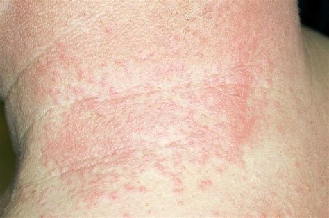 Shingles Rash On The Neck Photograph By Dr P Marazzi Science Photo Library 113960 Hot Sex Picture