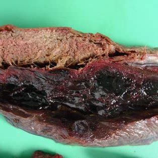 Appearance of a sub-chorionic hematoma at section for... | Download Scientific Diagram