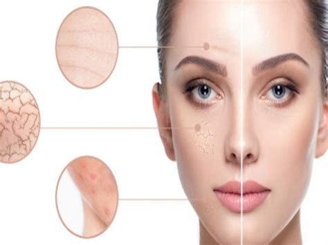 How To Remove Dark Spots On Face Caused By Pimples Naturally Atelier