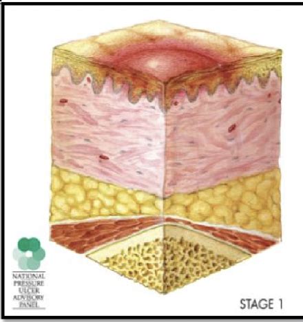 Pressure Ulcers Flashcards Quizlet