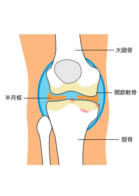 【半月板損傷は治らない？】半月板損傷の膝の痛みと治療について