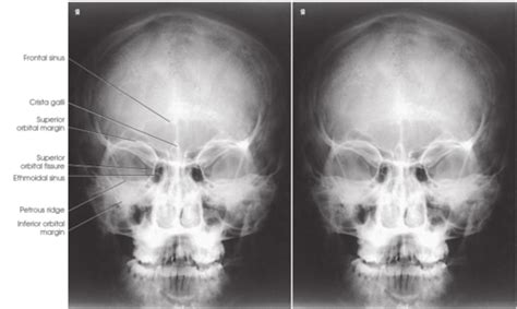 More Skull And Facial Bone Questions Flashcards Quizlet