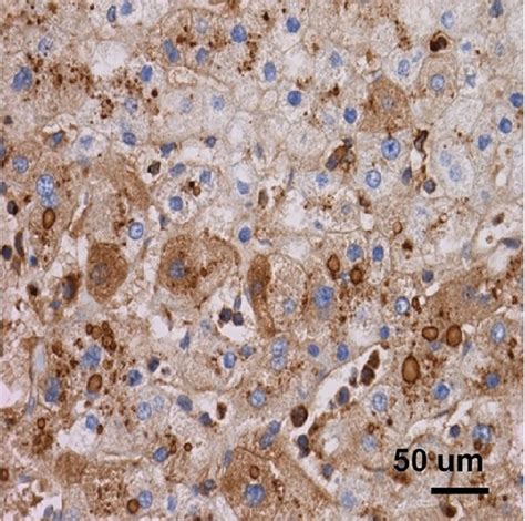 The Hepatocellular Adenoma Is Further Subtyped As Catenin Activated