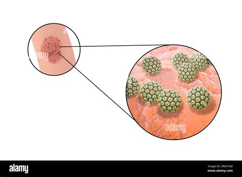 Penile Genital Warts And Close Up View Of Human Papilloma Virus