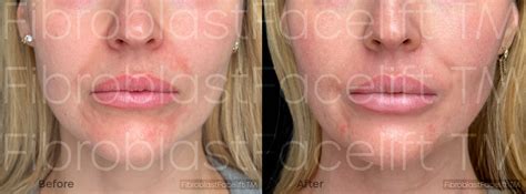 Fibroblast Face Treatments Fibroblast Facelift