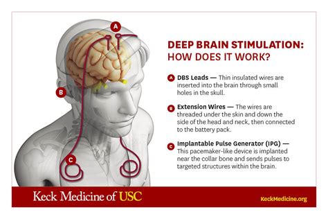 What Is Deep Brain Stimulation Keck Medicine Of USC What Is Deep