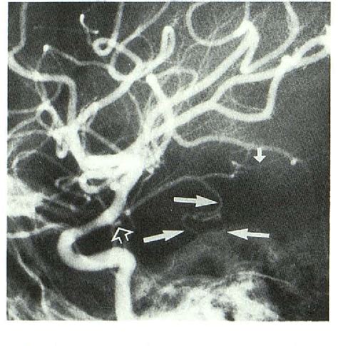 [PDF] Anterior choroidal artery: angiographic analysis of variations and anomalies. | Semantic ...