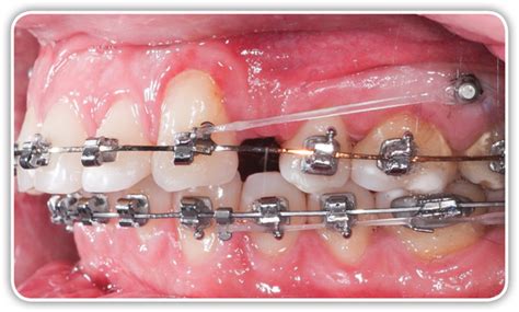 SPEED System Orthodontics