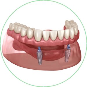 Dental Implants Fresno CA Alluvial Dental Center