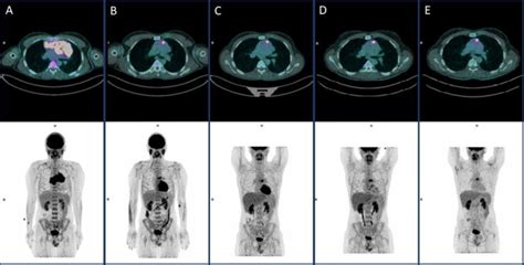 FDG PET Findings At A Baseline FDG PET B Interim FDG PET ABVD