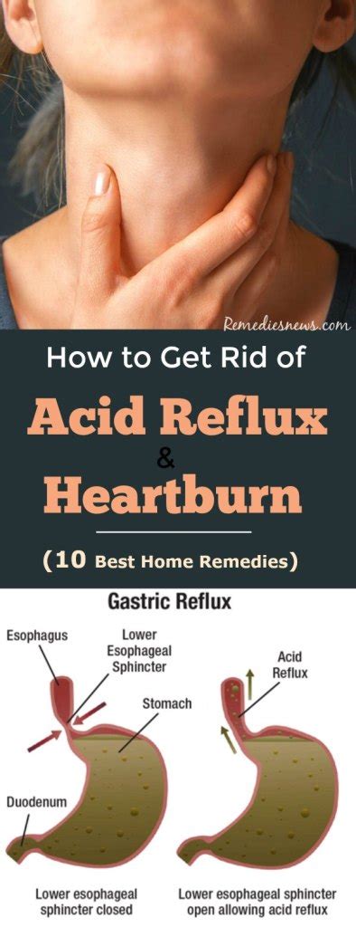 How To Get Rid Of Acid Reflux And Heartburn 10 Best Remedies