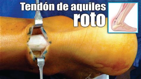 Lesiones Del Tend N De Aquiles Causas S Ntomas Tratamiento Y Cirug A