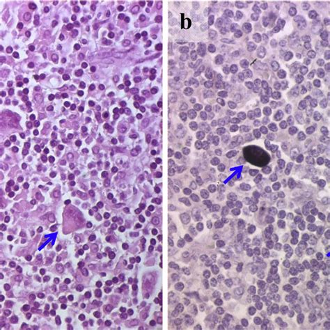 Ebv Positive Hodgkin Lymphoma Case Panel A Scattered Neoplastic