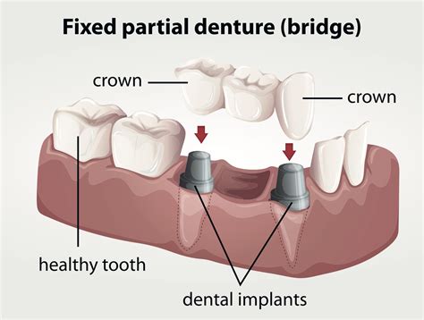 Dental Bridges In Irvine Missing Teeth Irvine Tooth Bridge Irvine