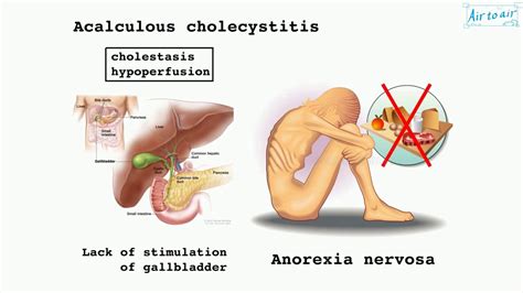 Acalculous Cholecystitis Diagnosis