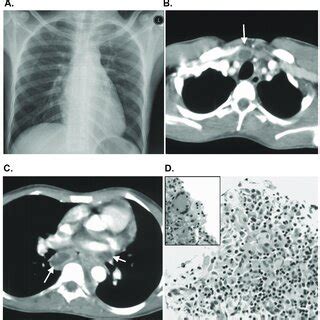 Chest X Ray With No Pathological Findings A Ct Scan Of The Thorax