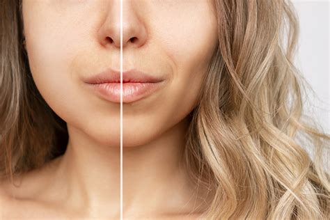 Is Buccal Fat Removal Worth It Lets Weigh The Benefits