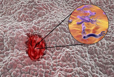 Mucosa Dello Stomaco Con Il Helicobacter Pylori Del Batterio E Dell