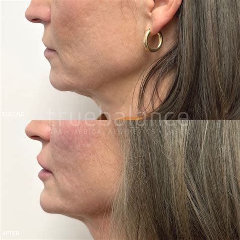 Filler True Balance Medical Spa