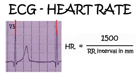 Heart Rate Calculation On Ecg Youtube