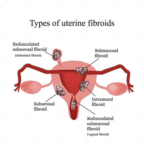 Types Of Uterine Fibroids Endometriosis Infographics Stock Vector