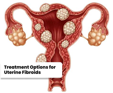 Uterine Fibroids Treatment: Surgery, Removal, and New Options | DoctorsApp