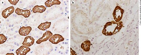 Figure 1 From Autosomal Dominant Tubulointerstitial Kidney Disease Due