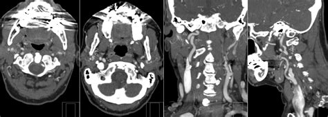 Radiology MRI: Persistent Hypoglossal Artery