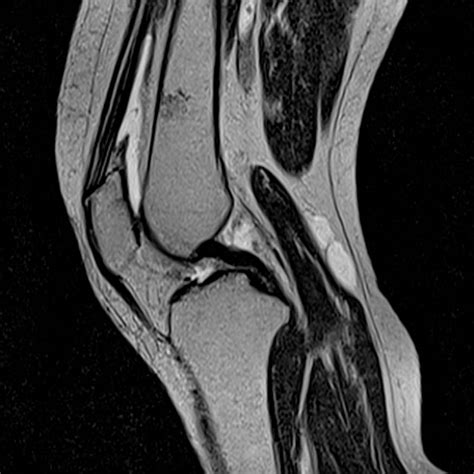 Resonancia Magn Tica De Rodilla Resonancia Magn Tica Panam