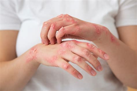 Understanding Psoriasis Causes Symptoms And Treatment Options Pure