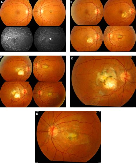 Figure From Long Term Follow Up Of Choroidal Neovascularization