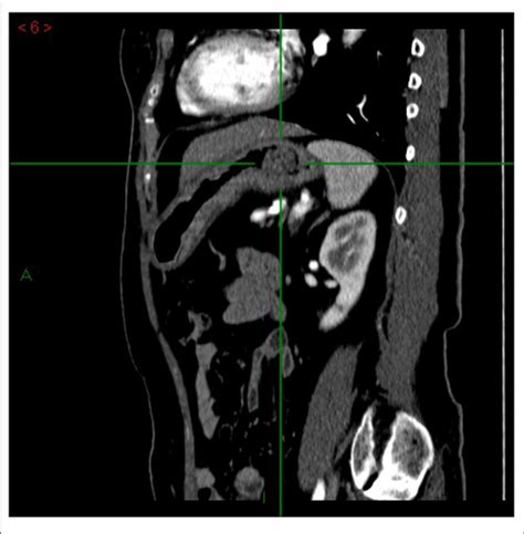 Multidetector Computed Tomography Mdct Arterial Phase Sagittal Download Scientific Diagram