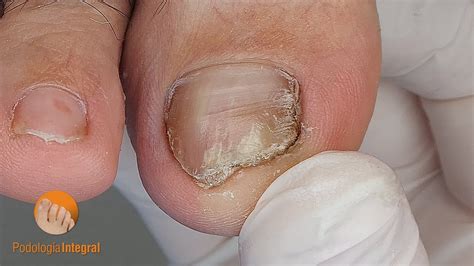 Nail Psoriasis And Onycholysis Nail Trimming And Cleaning Of The