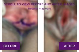 Perineoplasty Before And After Images And Videos Dr Michael Tahery