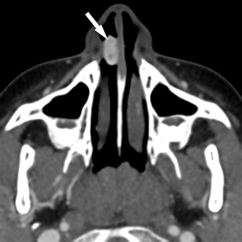 Masses Of The Nose Nasal Cavity And Nasopharynx In Children