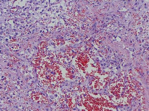 Neoplastic Tissue Consisting Of Epithelioid Cells Numerous