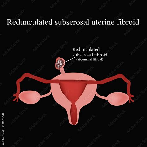 Pedunculated Subserous Uterine Fibroids Infographics Vector