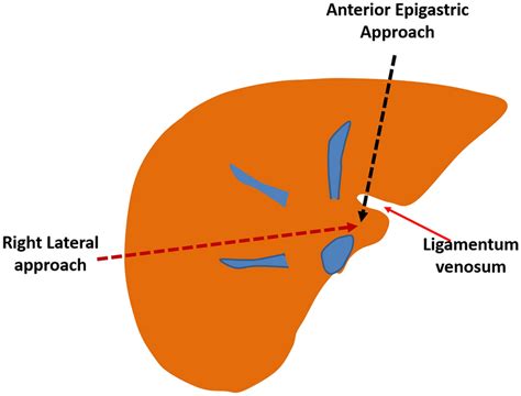 Schematic Diagram Demonstrating The Two Approaches For Percutaneous