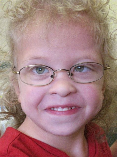 Noonan Syndrome Unusual Facies And Malformations