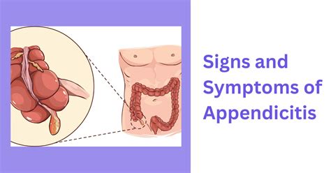 Appendicitis Diagnosis