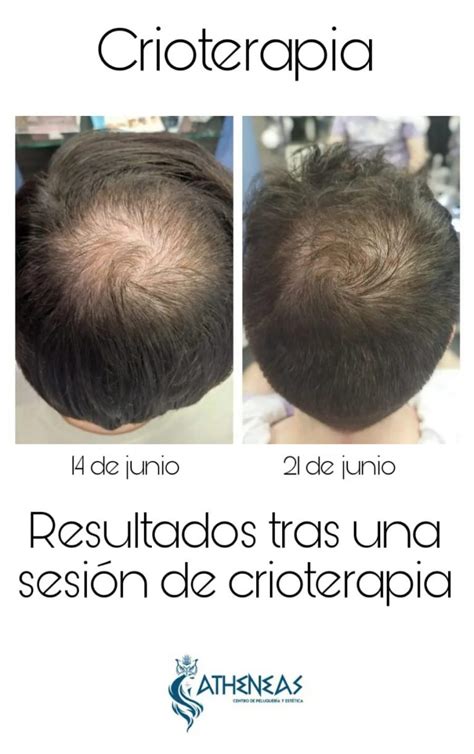 Cuidando Tu Cabello Crioterapia Capilar